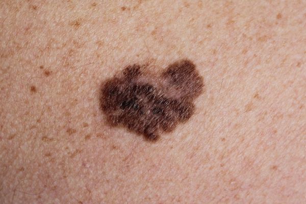 Grains de beauté : quand faut-il consulter un dermatologue ?